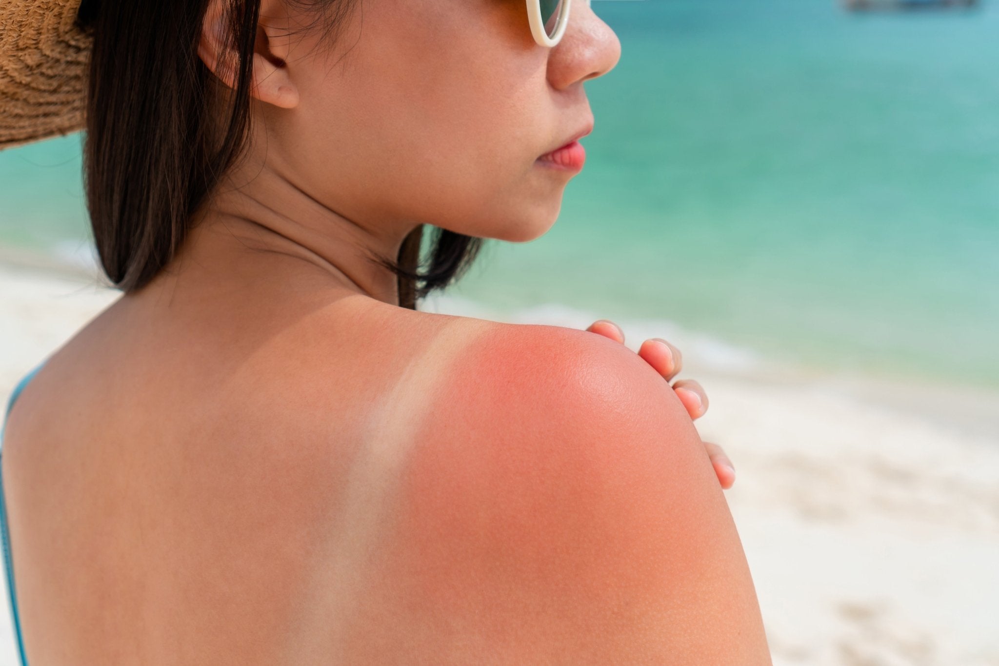 Quelle crème mettre après un coup de soleil ?