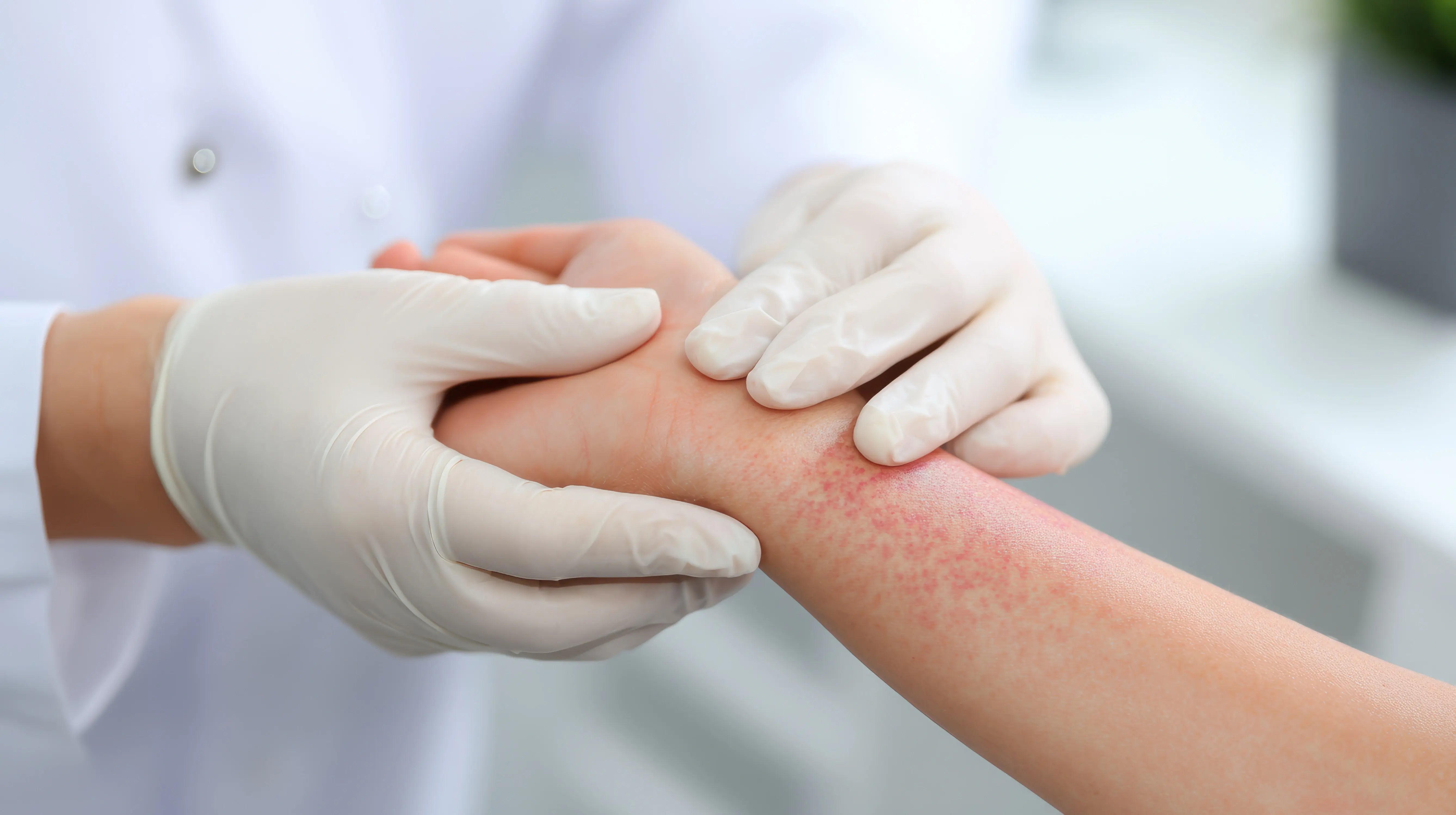 Eczéma atopique traitement