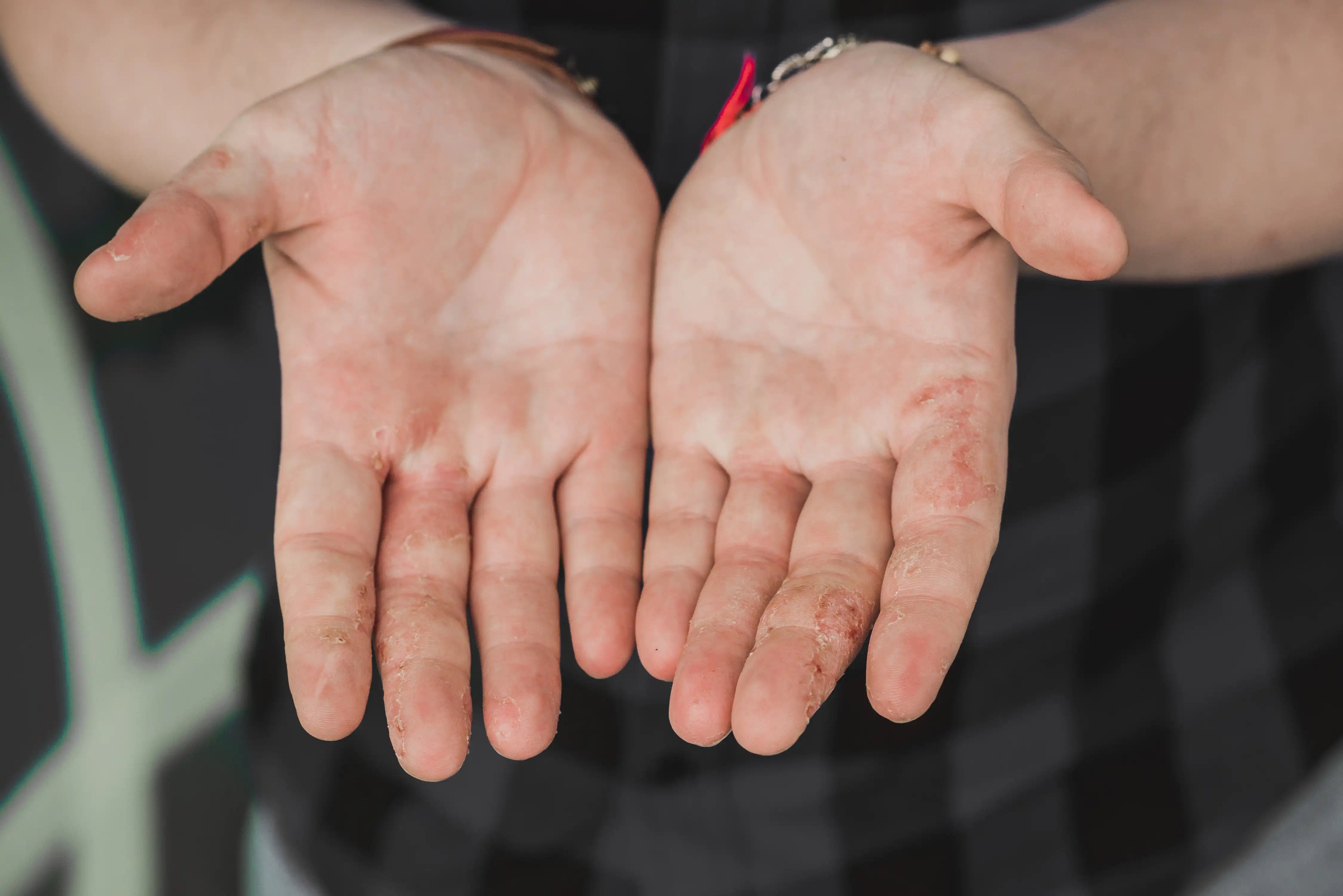 Dyshidrose - Eczéma bulleux Enfant