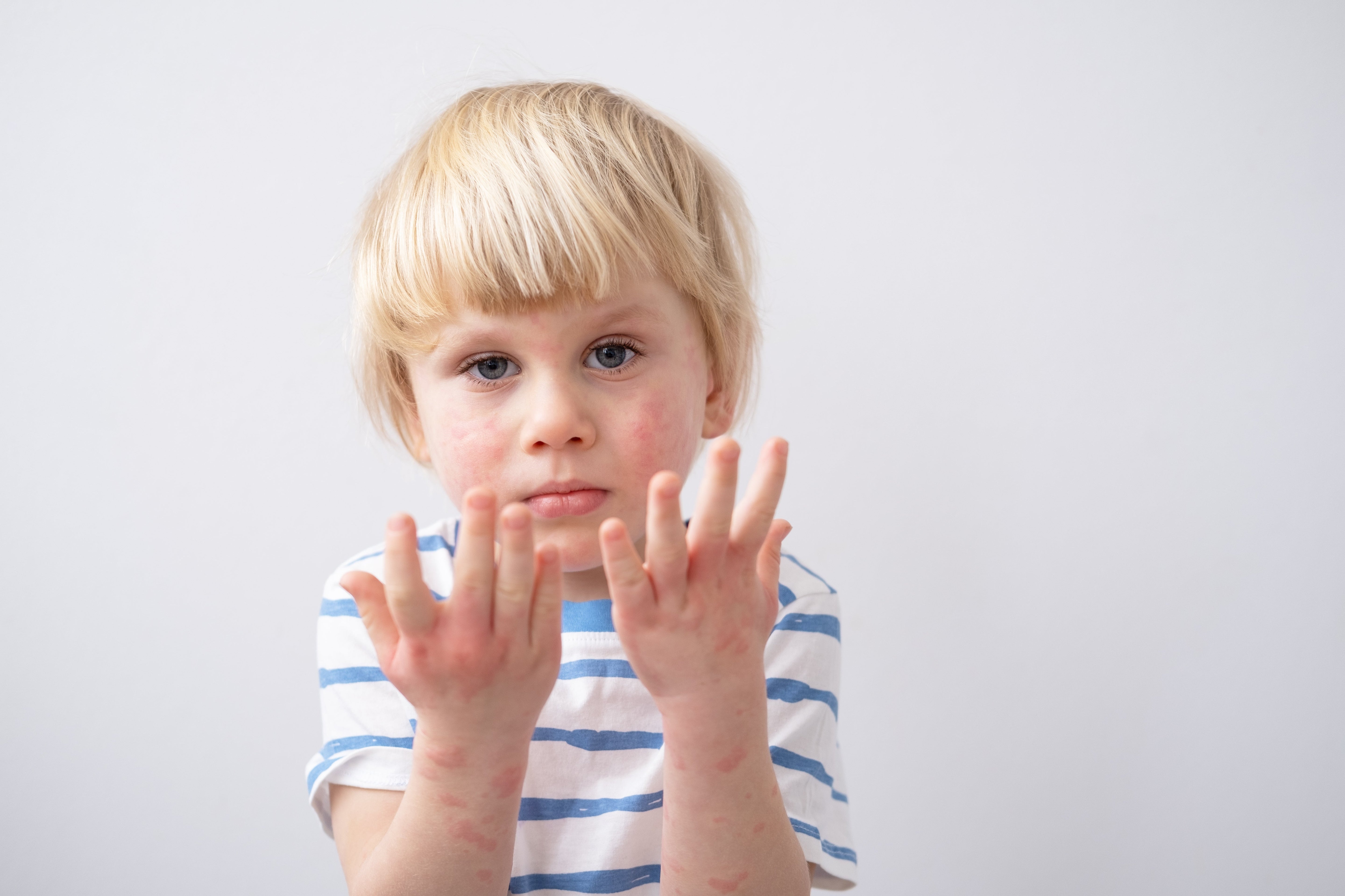 Microbiome cutané chez l'enfant : rôle, importance et conseils pour le préserver
